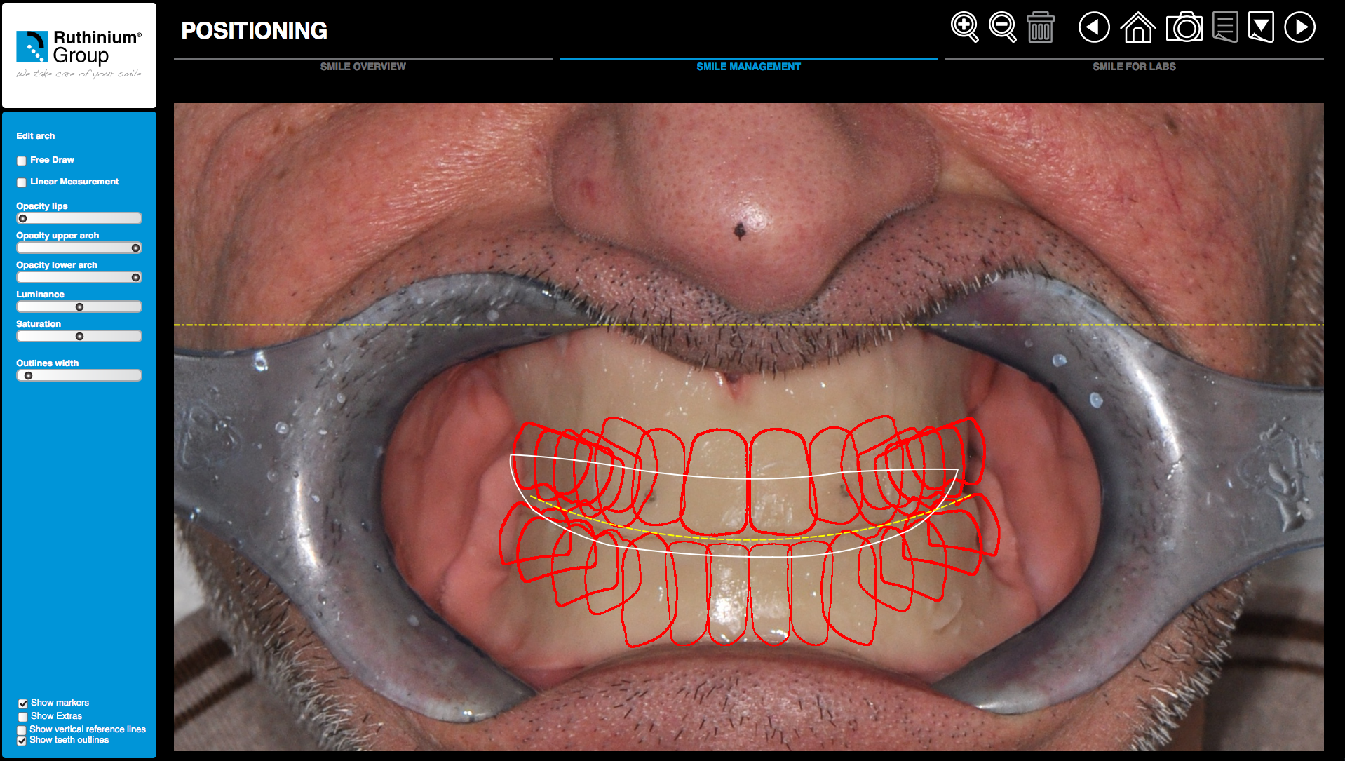 Funzionamento del flusso digitale denture guide 2D 3D Ruthinium