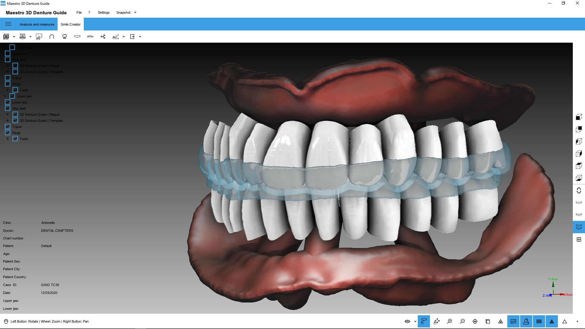 Funzionamento del flusso digitale denture guide 2D 3D Ruthinium